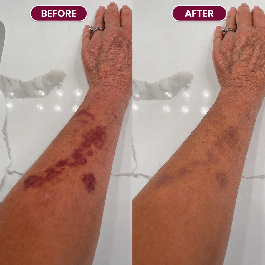 Bruising On Blood Thinners